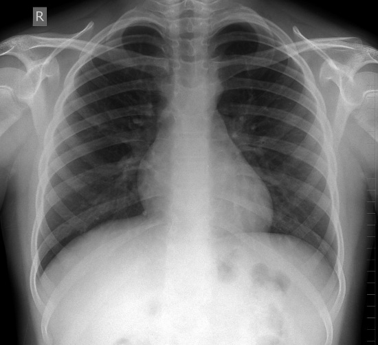 Chest X-ray